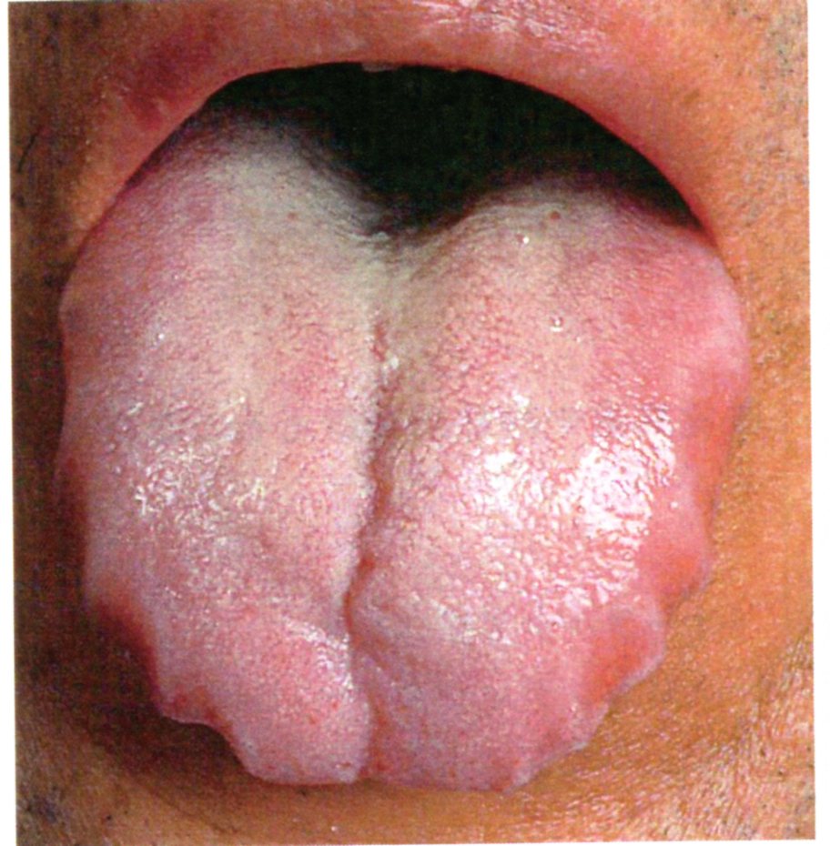 舌のデコボコな圧痕
